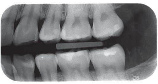 Viltužnik in Mekiš / Primerjava obsevanosti pacientov med panoramskim slikanjem in intraloralnim slikanjem statusa zob UVOD Stomatološka rentgenska diagnostika je del stomatološke klinične preiskave,