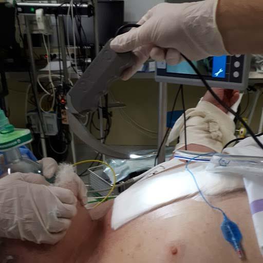 v sapnik. Težka intubacija z visoko incidenco zapletov pri bolnikih je narekovala razvoj novih pripomočkov, kot so videolaringoskopi.