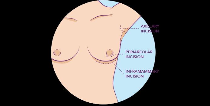 Stran 19 od 24 Slika 1: Anatomska mesta mogočih rezov pri povečanju prsi s silikonskimi vsadki. 13.4. Umestitev Eden od najpomembnejših dejavnikov pri uspešnem povečanju prsi je pravilna umestitev vsadka.