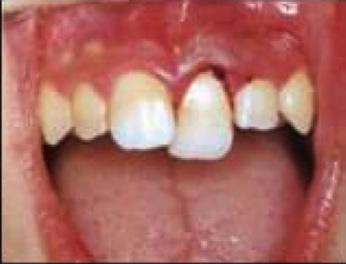 Pri poškodbah zobne pulpe je najpogosteje potrebno endodontsko zdravljenje zoba. Odlomljen del zoba bo zobozdravnik nadomestil z zalivko ali prevleko.