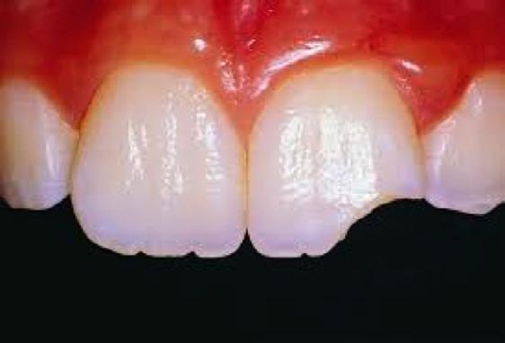 Kadar ima zob spremenjeno lego zaradi poškodbe, bo zobozdravnik zob povrnil v prvotno lego in ga imobiliziral. Potrebne so redne kontrole. Najhujša poškodba je izbitje zoba.