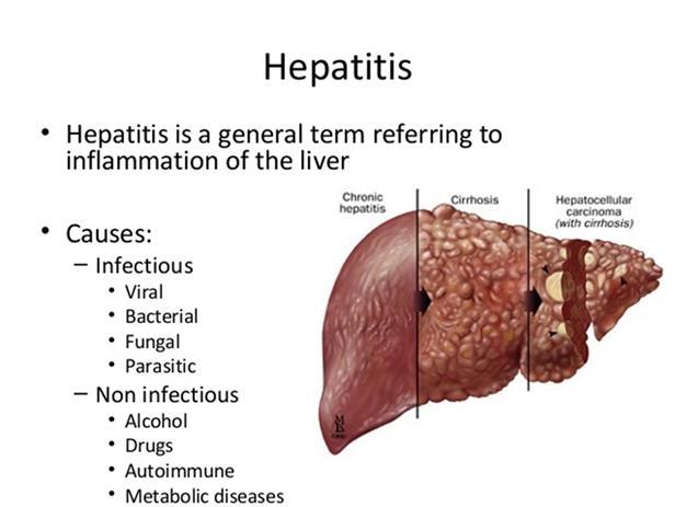 HEPATITIS - najpogostejši povzročitelji: virusi, alkohol, zdravila *