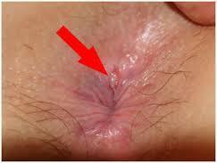 ), iritacija kože Posteriorna analna srednja linija začaran krog (akutna/kronična