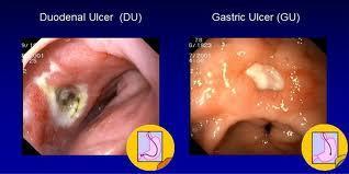 GASTRITIS/ ULKUSNA BOLEZEN NEZNAČILNA: pekoča, glodajoča bolečina, nelagodje v epigastriju, nespecifični simptomi dispepsije duodenalni