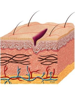 Kaj so strije? Strije so kožne razpoke oz. brazgotine, ki nastanejo zaradi prehitrega raztezanja kože.