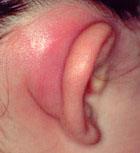 MASTOIDITIS Najpogostejša vnetna komplikacija akutnega vnetja srednjega ušesa Streptococcus