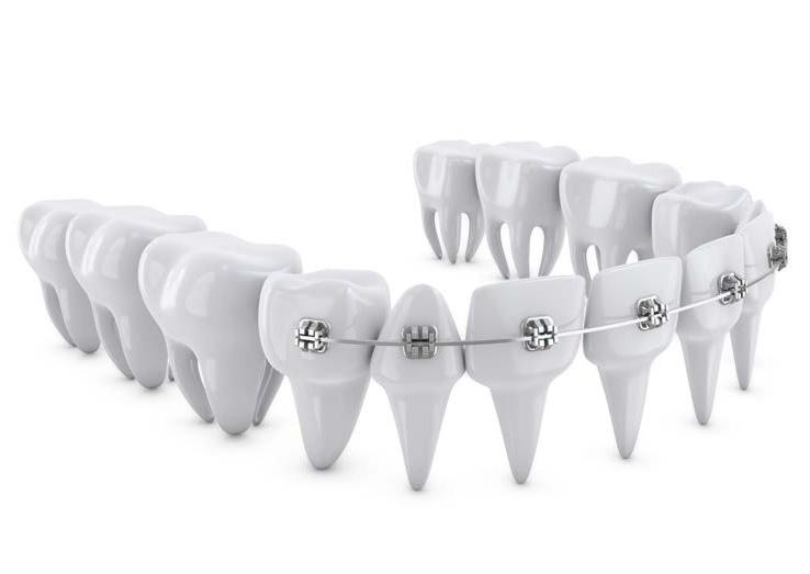 Ortodontija Ortodontija se ukvarja z reševanjem težav položaja zob, in sicer z uporabo kontinuiranih slabih sil, kar omogoča premik zob brez stranskih učinkov.