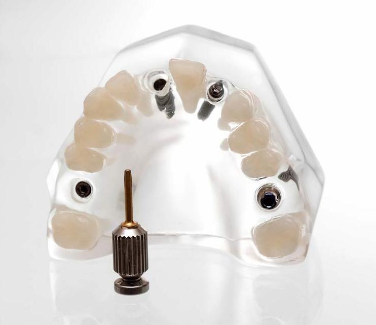 Tehnika All on Four Ta tehnika omogoča pacientu, da dobi»nove«zobe ob samo štirih vsadkih, na katere se pritrdi popolna proteza. Ta rešitev je optimalna za osebe, ki so izgubile večje število zob.