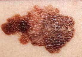 Žarki UV-B tudi zmanjšujejo sposobnost telesa za boj proti nekaterim nalezljivim boleznim, kjer prihaja do okužbe skozi kožo.