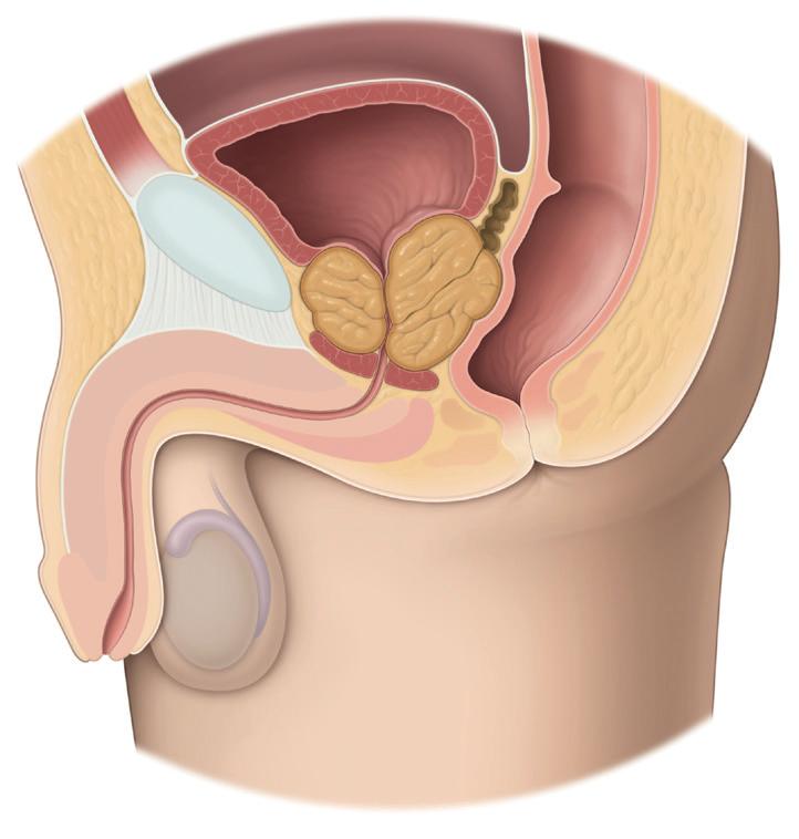 Benignem povečanju prostate Kaj je prostata? Prostata je žleza, ki se nahaja v spodnjem urinarnem traktu natanko pod mehurjem in obdaja sečnico (Slika 1). Najdemo jo le pri moških.