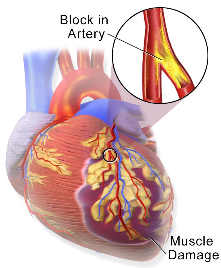 SRČNI INFARKT klinična slika neprehodna koronarna arterija popolno zaprtje veje koronarne arterije ishemija področja miokarda, ki ga zaprta