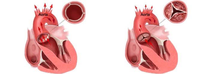 letu starosti) dvolistna aortna zaklopka (srednje