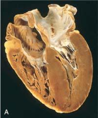 AORTNA STENOZA klinična slika moten iztok iz levega ventrikla hipetrofija levega ventrikla v mirovanju hipertrofični miokard iztisne zadosten minutni volumen