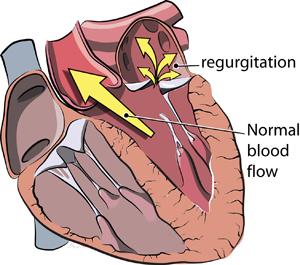 MITRALNA INSUFICIENCA vračanje krvi v levi atrij - regurgitacija normalno odtekanje krvi v aorto VZROKI: prolaps mitralne zaklopke infekcijski