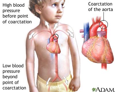 Koarktacija aorte visok krvni tlak pred koarktacijo nizek krvni tlak za koarktacijo koarktacija zožitev aorte kolateralni pretok preko interkostalnih arterij