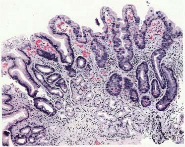 Slika 4: Kronični gastritis (Na levi strani je prikazana antralna sluznica želodca, ki na desni strani prehaja v črevesno sluznico. V sluznici je izražena zmerna atrofija žlez.