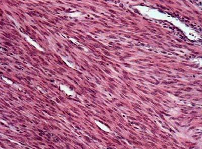 28) Slika 5: Leiomiom (Prepleti vretenastih celic s podolgovatimi, ob koncih zaobljenimi cigarastimi jedri.) Vir: Cerar (2006, str. 121) 3.5.2 Maligni tumorji Epidemiologija Najpogostejši želodčni maligni tumor je adenokarcinom ali žlezni rak.