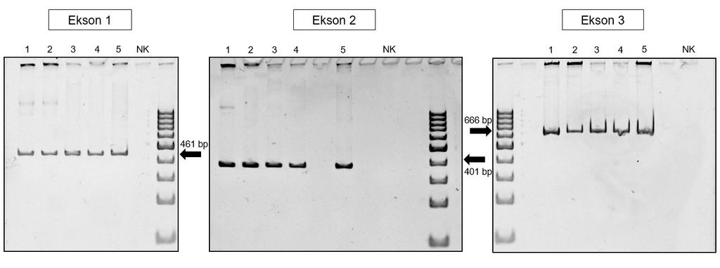34 4.3 POMNOŽEVANJE REGIJ GENA HBB PRI BOLNIKIH S pomočjo vzpostavljenega protokola za pomnožitev regij treh eksonov gena HBB smo z izbranimi pogoji reakcije PCR (Preglednica 9, Preglednica 10 in