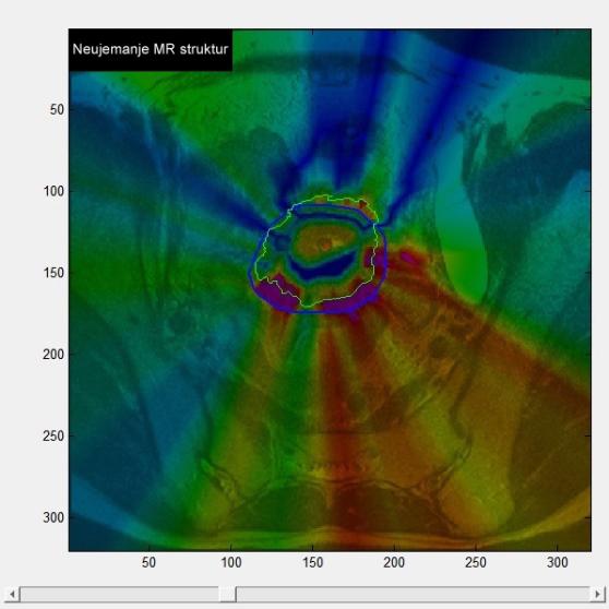 Univerza na Primorskem, Fakulteta za matematiko, naravoslovje in informacijske tehnologije, 2014 29 Slika 12: Prikaz razlike razdalj med preslikanim obrisom iz CT slike (zelen obris) in ekspertnim