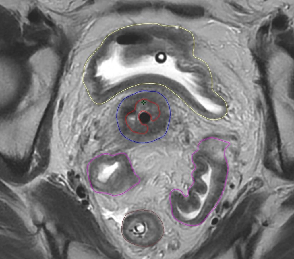 Slika 4: Vrisane konture tarčnih volumnov: GTV (rdeča barva) in HR-CTV (modra barva), ter kritičnih organov: Danke (rjava barva), Sigmoidnega črevesa (vijolična barva), Mehurja (rumena barva) 3.