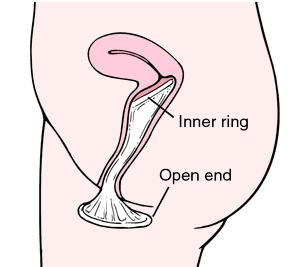endometrija ob HNZ 3 % S spermicidi Odstranitev: 6 do 24 ur po SO