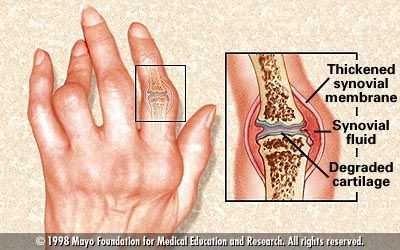 Artritis Artritis je revmatična bolezen, povzroča ga vnetje sklepov.