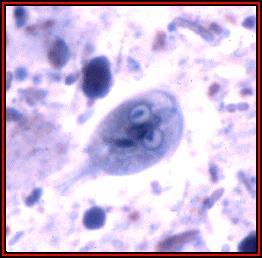 Slika 2 4: Fotografija Giardije lamblije pod optičnim (levo) in elektronskim (desno) mikroskopom. Bolezen ima atipične znake, razen ko gre ţe za akutno razvito fazo.