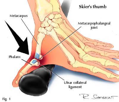 Slika 1: Mehanizem nastanka poškodbe palca (Hand and Wrist Injuries in Winter Sports, 2001). Ramenski obroč sestavljata levi in desni del, ki nista neposredno povezana.