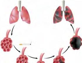 Kajenje škoduje zdravju Kajenje povzroča številne težave, od jutranjega kašljanja do raka. Obstaja le ena rešitev nikoli začeti kaditi ali čimprej prenehati.