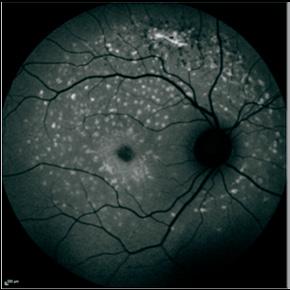 Slika 3. Avtofluorescenca očesnega ozadja desnega in levega očesa dveh bolnikov s Stargardtovo boleznijo in različnimi mutacijami v genu ABCA4.