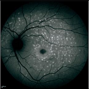 Leberjeva hereditarna optična nevropatija (LHON), geni ND1, ND4 in ND6 LHON je bolezen vidnega živca, za katero je značilna izguba ganglijskih celic in subakutna izguba centralnega vida, navadno pri