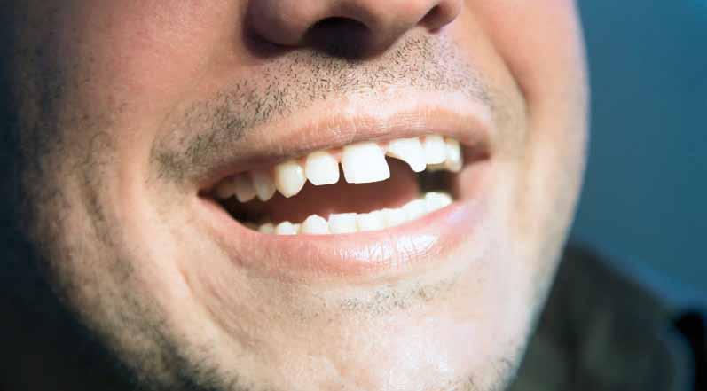 36 Maj 2017 A Fiziološka obraba zob, ki pride z leti, je normalen pojav. B Skrb za ustno zdravje je eden najpomembnejših pogojev za ohranjaje zdravja v celoti.