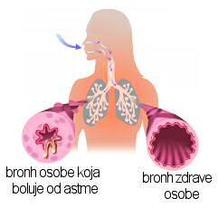 2. Osnovno o astmi Astma je kronično vnetje dihal in ima jo približno 14% vseh ljudi, po nekaterih virih več, po nekaterih manj. Pri nas ima astmo od 50,000 do 100,000 ljudi. Vzrok astme ni znan.