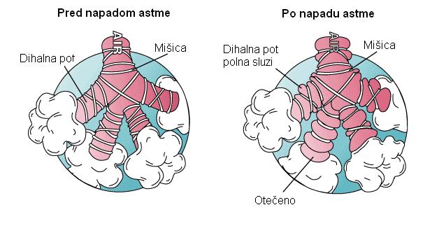Slika 2: Stanje zračnih poti pred in po napadu astme Na sliki vidimo stanje zračnih poti pred in po napadu astme.