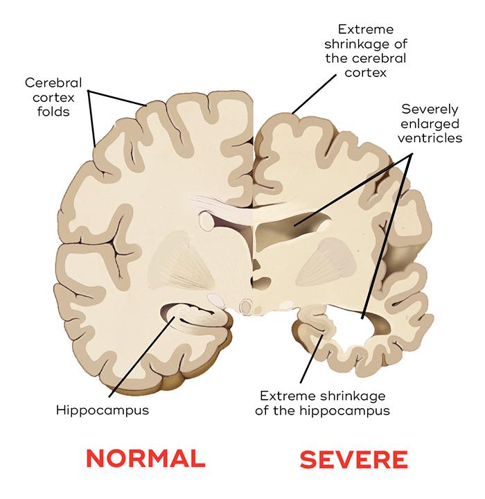 Primerjava možganov zdravega človeka z možgani posameznika, obolelega za AD (Povzeto po Dementia