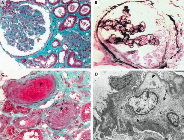 Trombotična mikroangiopatija Patološka diagoza: karakterističen zadebeljen endotelij arteriol in kapilar z mikrovaskularno trombozo, ki povzroči mikroangiopatsko hemolitično anemijo ter