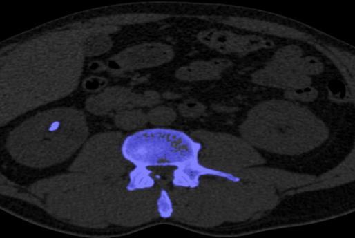 Slika 17: DECT kalcijev kamen na različni višini v desni ledvici (arhiv Splošne bolnišnice Murska Sobota oddelek za Radiologijo) Slika 18: DECT - uratni in kalcijev kamen na različni višini v levi