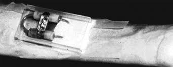 Willem Kolff punkcija iglama iz a. femoralis u venu 1960.