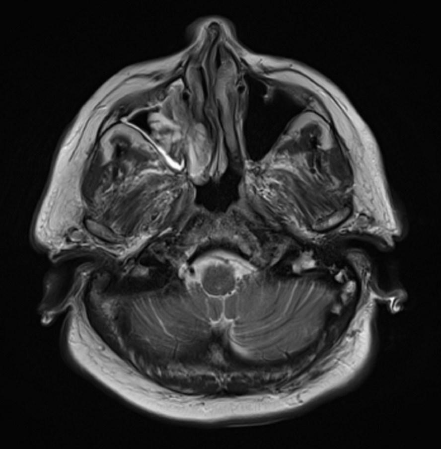 Slika 4. Invertirani papilom na MR sliki obnosnih votlin v transverzalni ravnini. Invertirani papilom v desni čeljustni votlini in v zadnjem delu desne nosne votline.