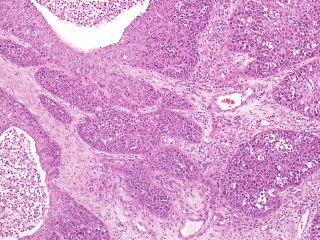 Slika 11. Neporoženevajoči invazivni ploščatocelični karcinom, gradus II z mikro abscesi, ki je vzniknil ob invertiranem ploščatoceličnem papilomu. 1.1.6 Etiologija Etiologija IP še ni pojasnjena (48,66).