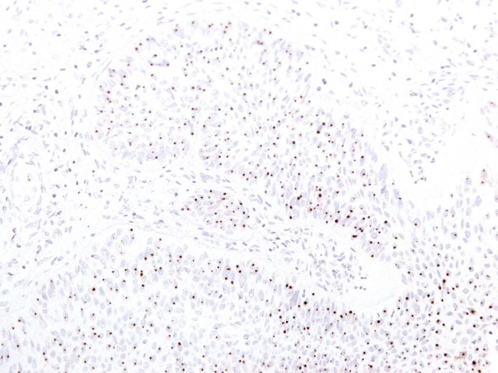 Slika 13. Dokaz integracije in transkripcijske aktivnosti HPV v ploščatoceličnemu karcinomu v invertiranemu papilomu.