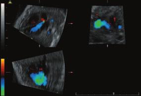 MED RAZGL 2006; 45 Slika 12. Prikaz levega izto~nega trakta srca z metodo STIC v 28. tednu nose~nosti. ~unano konstrukcijo. STIC-tehnologija se lahko uporablja za prikaz srca od 13. do 40.