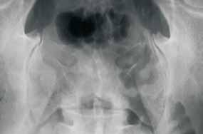 diagnostična radiologija Slika : odstotki pacientov, pri katerih se pojavi artritis po, istočasno in pred pojavom kožne luskavice rtritis ali pa se pojavijo sočasno z njim.