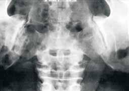 diagnostična radiologija Predvsem pri mlajših pacientih (< 30 let) se rentgenolog šele na podlagi osnovnega AP aksialnega posnetka odloči, če sta potrebna še polstranska posnetka.