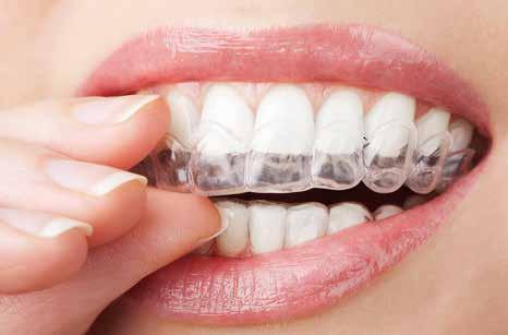 Ko začne videz zob vplivati na vaše vsakdanje življenje, je čas za spremembo. Beljenje zob je estetski poseg, ki vam bo spremenil življenje in vam povrnil izgubljeno samozavest.