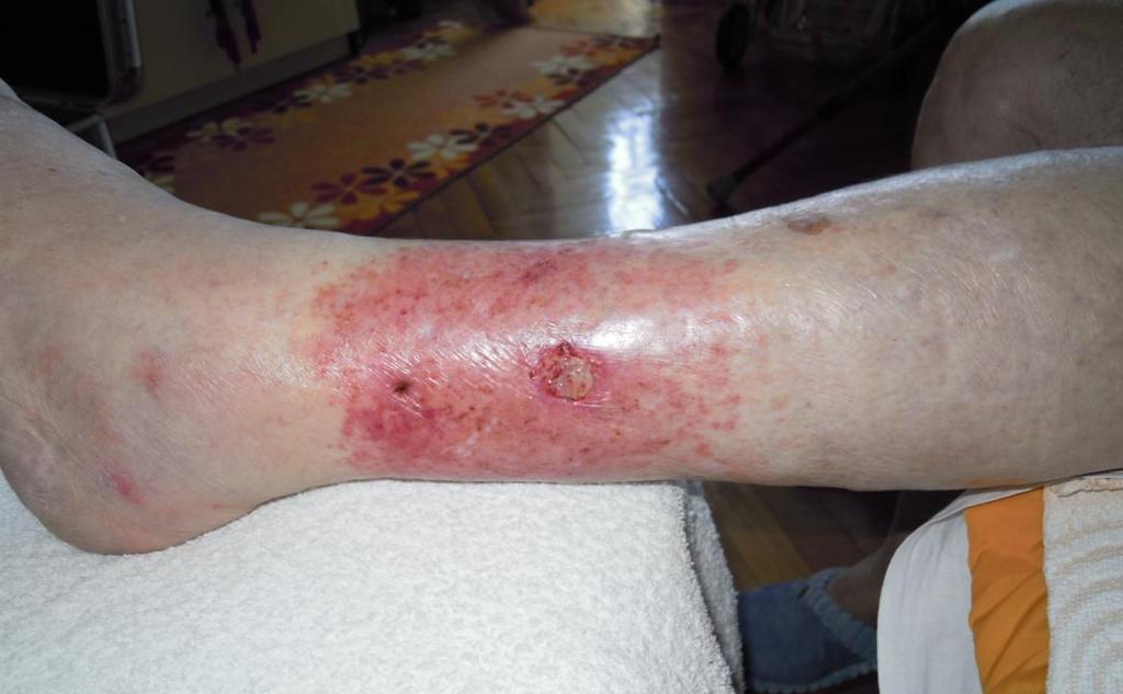 Slika 6: Primer rane na levi goleni pred