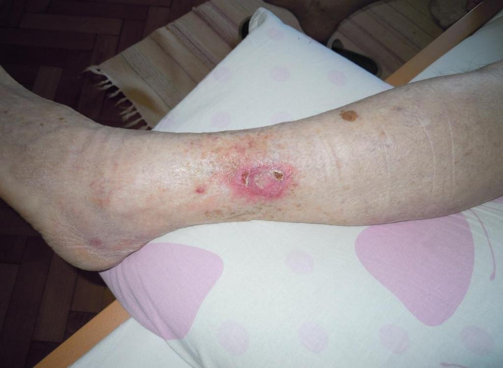 Slika 7: Primer rane na levi goleni po