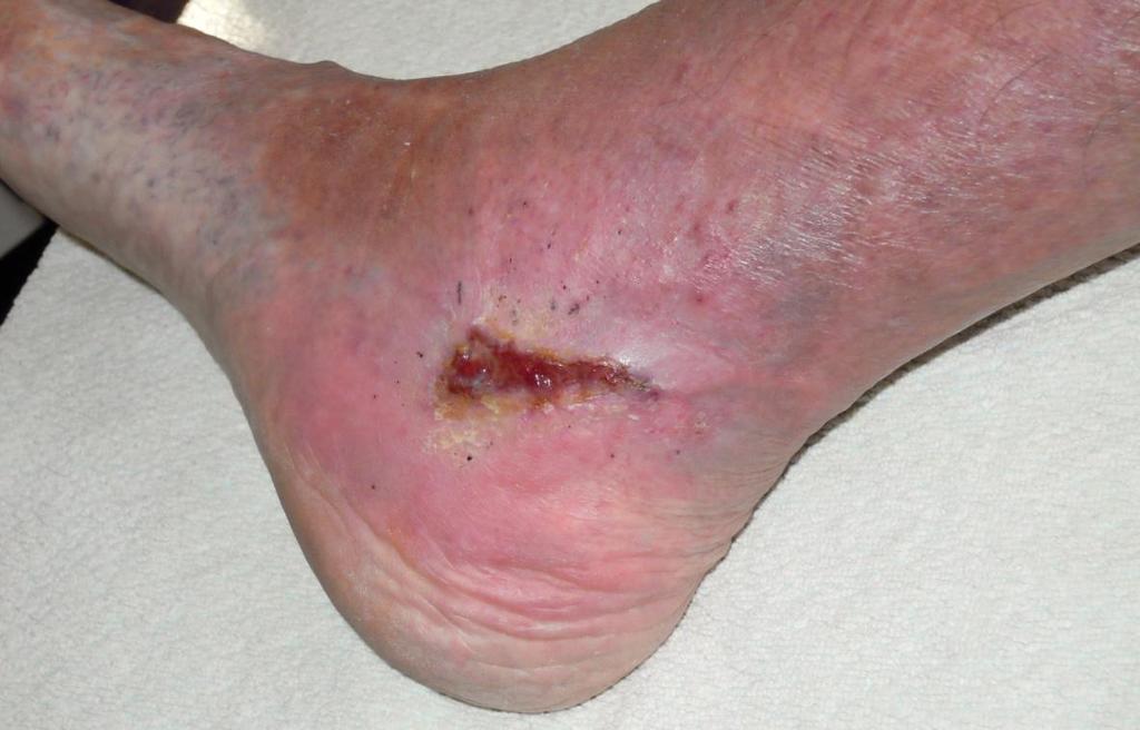 Slika 10: Primer rane pri 80-letnem bolniku