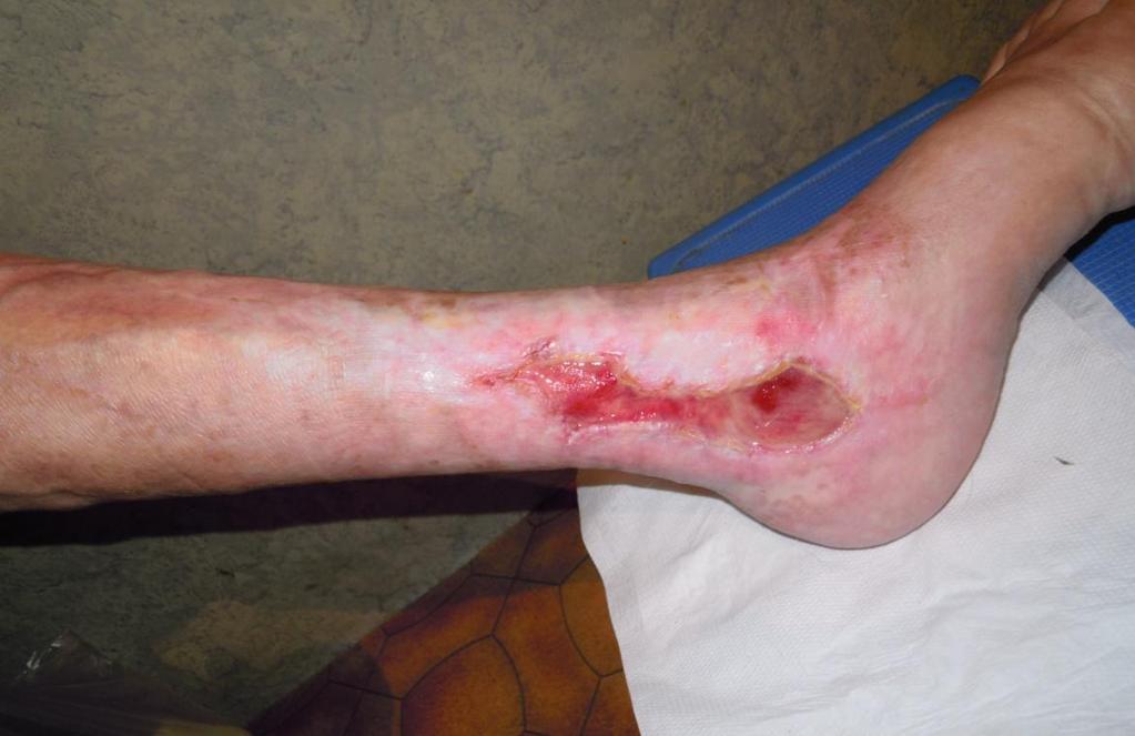 Slika 12: Primer rane na levi goleni pred