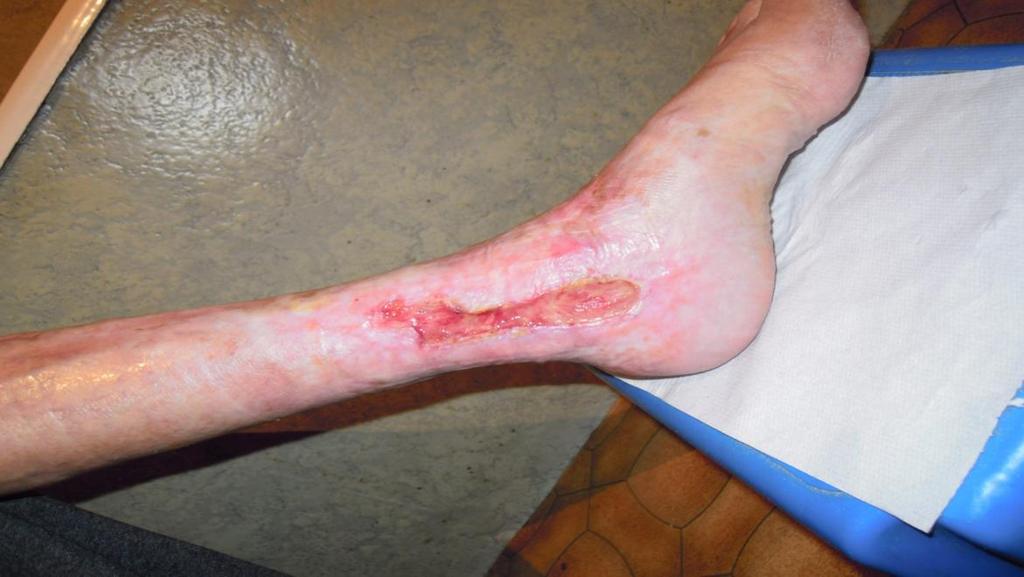 Slika 13: Primer rane na levi goleni po